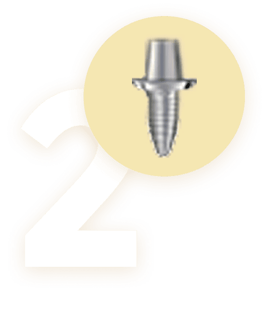 Biểu tượng bước 2 trong quy trình trồng răng Implant