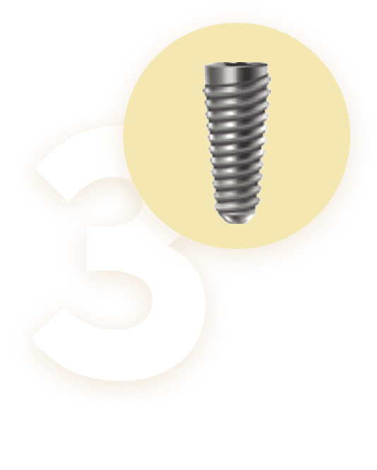 Biểu tượng bước 3 trong quy trình trồng răng Implant