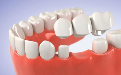 Phục hình thẩm mỹ