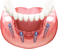 Mô hình 3D phục hình Implant nhiều răng – minh họa kỹ thuật cố định răng giả cho bệnh nhân mất răng toàn bộ tại Nha Khoa Phương Thành