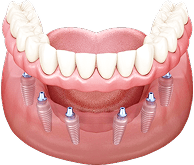 Mô hình 3D phục hình toàn hàm dưới – minh họa kỹ thuật cố định răng giả cho bệnh nhân mất răng toàn bộ tại Nha Khoa Phương Thành