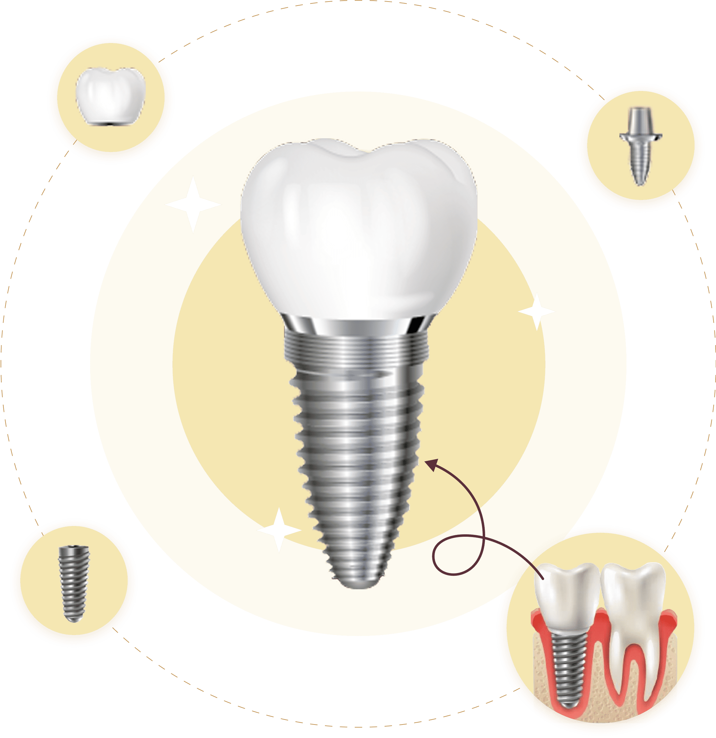 Hình ảnh 3D cấu tạo Implant nha khoa – gồm mão sứ, khớp nối, trụ titan và mô phỏng so sánh với răng thật, minh họa quy trình trồng răng tại Nha Khoa Phương Thành