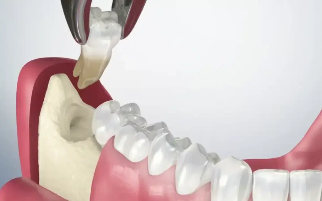 Tạm biệt nổi ám ảnh răng khôn