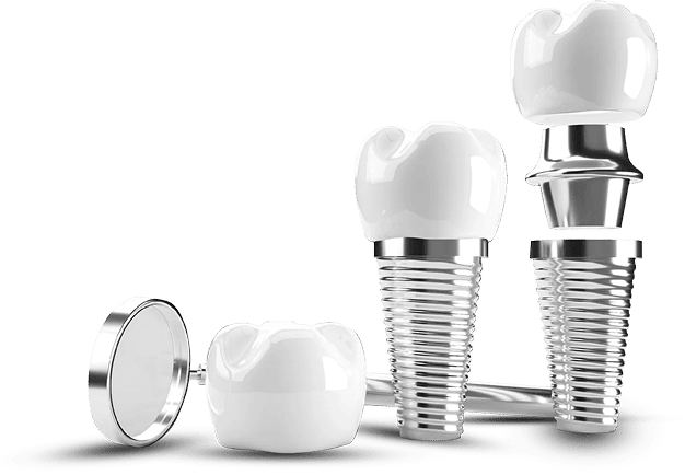 Hình ảnh 3D các bộ phận của Implant nha khoa – gồm trụ titan, khớp nối và mão sứ, minh họa quy trình phục hồi răng giả tại Nha Khoa Phương Thành