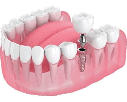 Mô hình 3D quy trình trồng răng Implant – hiển thị trụ Implant, khớp nối và mão răng giả, minh họa kỹ thuật phục hồi răng tại Nha Khoa Phương Thành