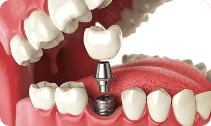 Trồng răng Implant 1 răng