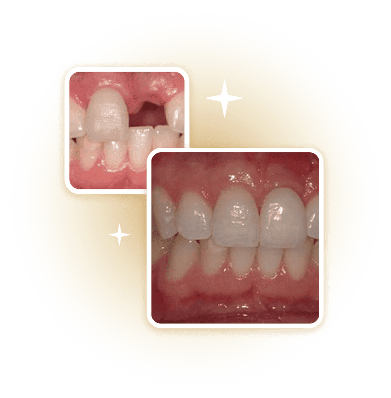 So sánh trước và sau điều trị nha khoa – hình ảnh cải thiện nướu và màu răng, minh họa hiệu quả dịch vụ chăm sóc răng miệng tại Nha Khoa Phương Thành