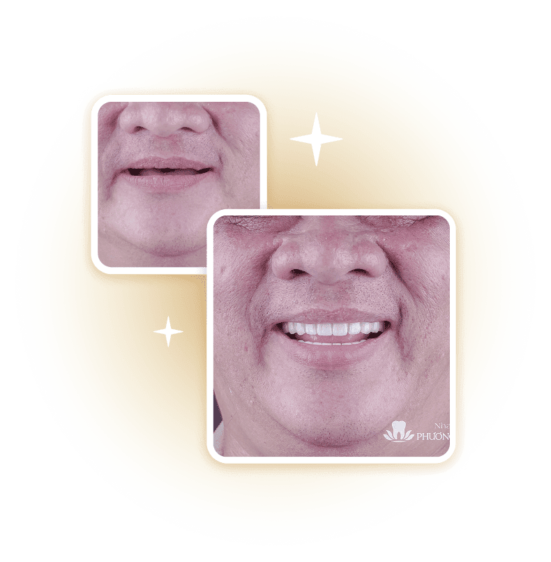 So sánh trước và sau điều trị thẩm mỹ nha khoa – cải thiện màu sắc và hình dáng răng, minh họa hiệu quả dịch vụ tại Nha Khoa Phương Nam