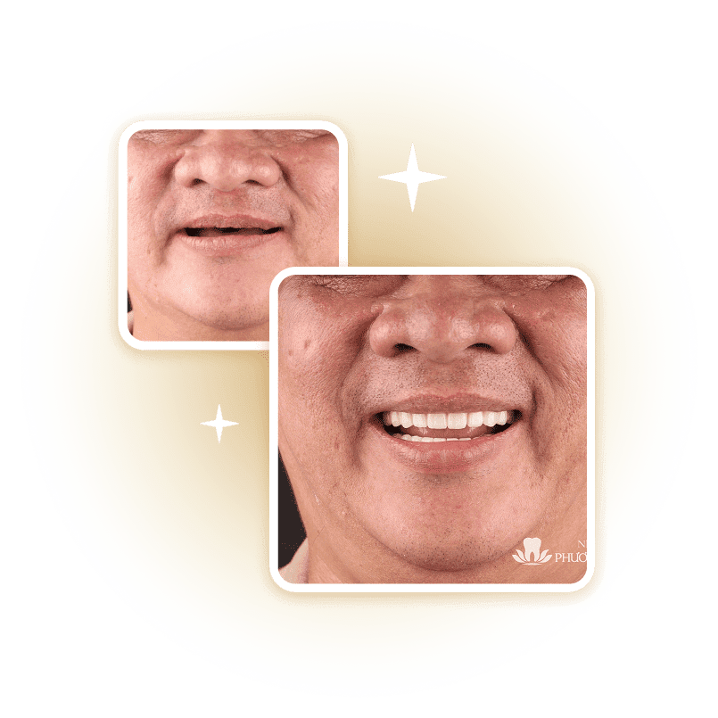 So sánh trước và sau điều trị thẩm mỹ nha khoa – cải thiện màu sắc và hình dáng răng, minh họa hiệu quả dịch vụ tại Nha Khoa Phương Nam