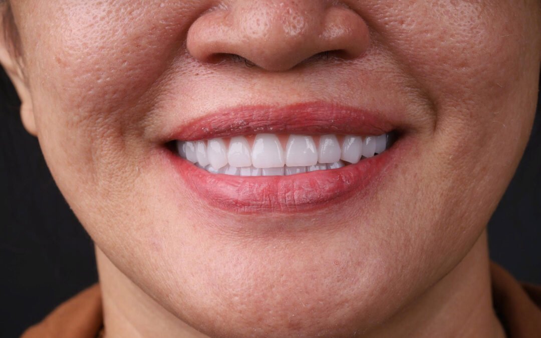 Trồng răng Implant toàn hàm