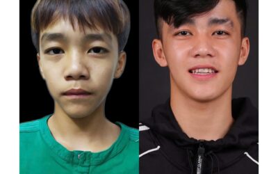 Hơn 4 năm kiên trì đổi lấy nụ cười rạng rỡ