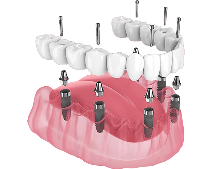 trồng răng implant
