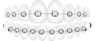 Mô phỏng niềng răng mắc cài kim loại trên răng hàm trên và dưới – phương pháp chỉnh nha truyền thống tại Nha Khoa Phương Thành