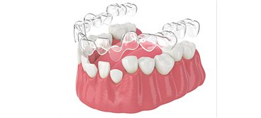 Mô phỏng khay niềng trong suốt ôm sát răng – giải pháp chỉnh nha thẩm mỹ không mắc cài tại Nha Khoa Phương Thành