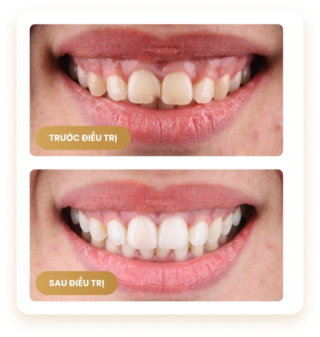 Nụ cười trước và sau điều trị – cải thiện màu sắc, đường viền nướu và thẩm mỹ tại Nha Khoa Phương Thành