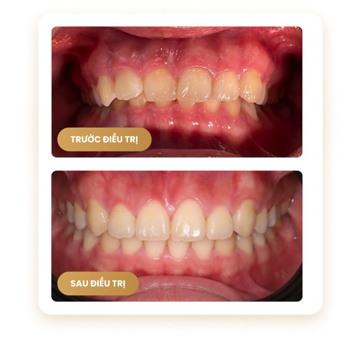 Hình ảnh răng trước và sau điều trị – cải thiện đều đặn, màu sắc và khớp cắn tại Nha Khoa Phương Thành