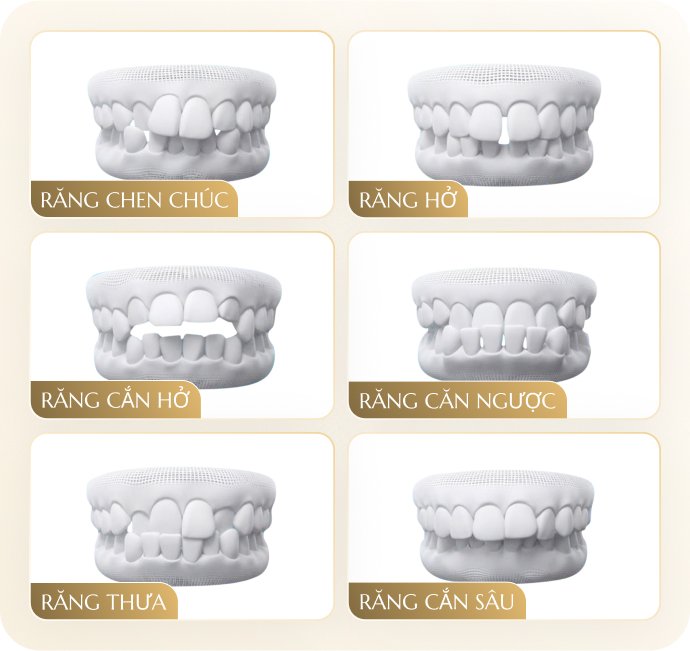 Mô phỏng các dạng sai lệch khớp cắn: chen chúc, hở, cắn hở, cắn ngược, thưa, cắn sâu – tư vấn chỉnh nha tại Nha Khoa Phương Thành