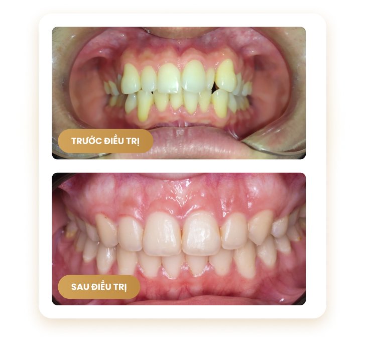 So sánh răng trước và sau điều trị – cải thiện màu sắc, đều đặn và thẩm mỹ tại Nha Khoa Phương Thành