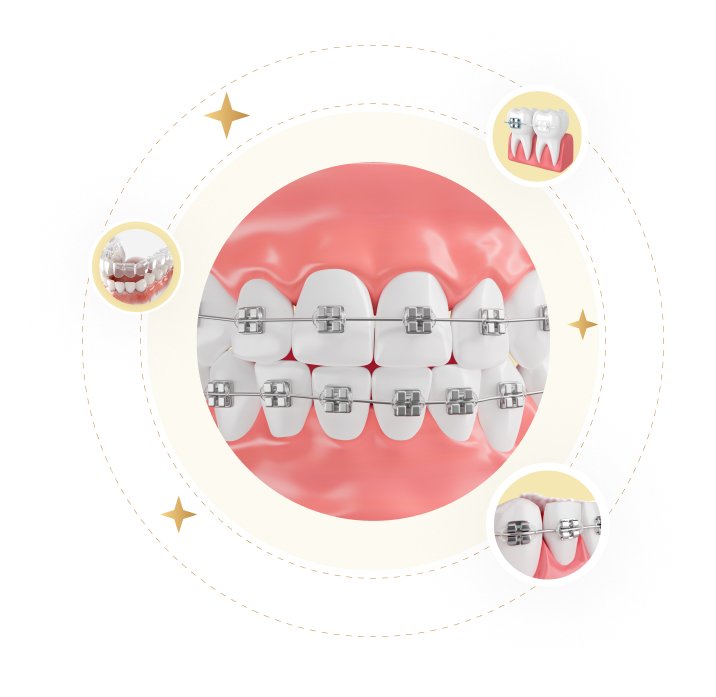 trồng răng implant