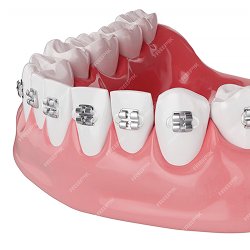 Mô hình hàm răng với mắc cài kim loại – minh họa quy trình niềng răng tại Nha Khoa Phương Thành