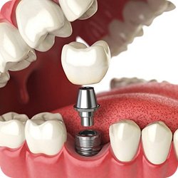 Mô phỏng quy trình cấy ghép implant với trụ titanium, khớp nối và mão sứ – phục hình răng mất tại Nha Khoa Phương Thành