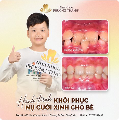 Hành trình phục hồi nụ cười cho bé tại Nha Khoa Phương Thạnh – cải thiện răng sâu và lệch lạc, kiến tạo hàm răng khỏe đẹp