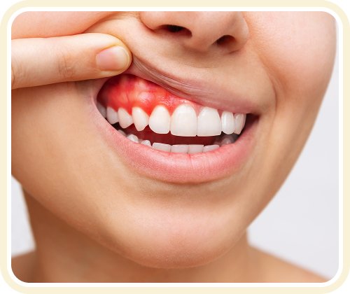 Nướu đỏ và sưng do viêm – cảnh báo sức khỏe răng miệng tại Nha Khoa Phương Thành