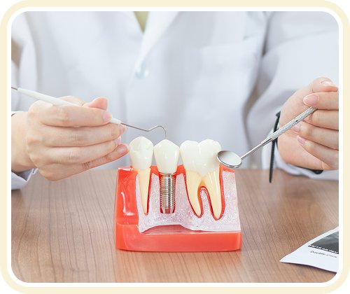 Bác sĩ nha khoa minh họa quy trình cấy ghép implant bằng mô hình răng – phục hình răng mất tại Nha Khoa Phương Thành