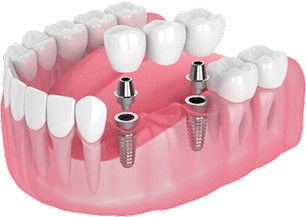 trồng răng implant 1 vài răng