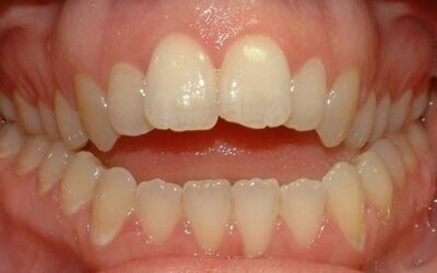 Tật đẩy lưỡi ảnh hưởng đến khả năng ngôn ngữ và sự phát triển của hàm