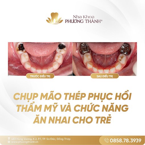 Phục hồi răng sâu cho trẻ bằng mão thép – cải thiện thẩm mỹ và chức năng ăn nhai tại Nha Khoa Phương Thành