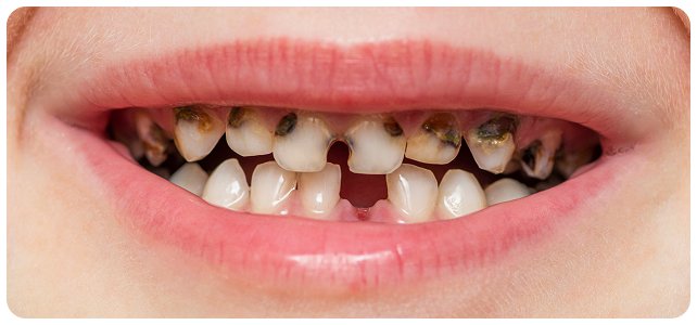 Răng sâu nặng và hư tổn nghiêm trọng – cảnh báo hậu quả khi không chăm sóc răng miệng đúng cách