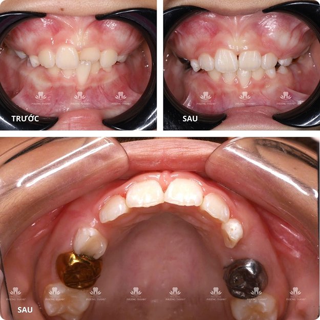 So sánh răng trước và sau điều trị – phục hồi thẩm mỹ và chức năng ăn nhai bằng mão răng tại Nha Khoa Phương Thành