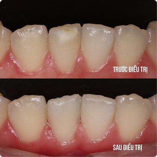 Răng cửa bị đổi màu được phục hồi thẩm mỹ – kết quả điều trị tại Nha Khoa Phương Thành