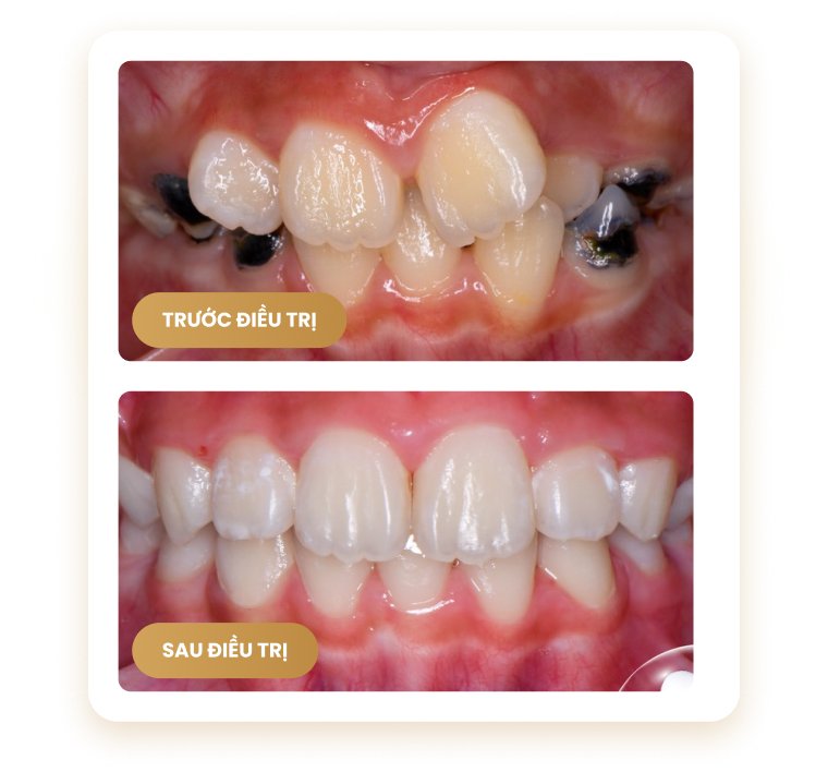 So sánh răng trước và sau điều trị – cải thiện răng lệch lạc và sâu tại Nha khoa Phương Thành