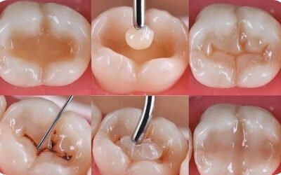 Điều trị tuỷ răng