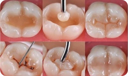 Điều trị tuỷ răng