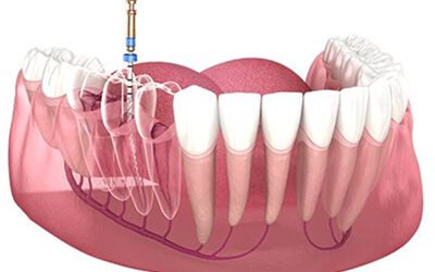 Trám răng thẩm mỹ