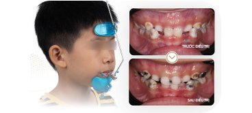 Trẻ em đeo khí cụ chỉnh nha – hiệu quả điều trị răng lệch lạc tại Nha khoa Phương Thành