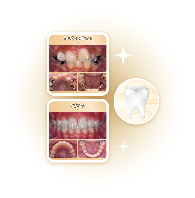 So sánh toàn diện răng trước và sau điều trị – cải thiện khớp cắn và thẩm mỹ tại Nha khoa Phương Thành