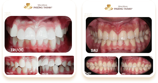 So sánh răng trước và sau điều trị – cải thiện thẩm mỹ và khớp cắn tại Nha khoa Phương Thành
