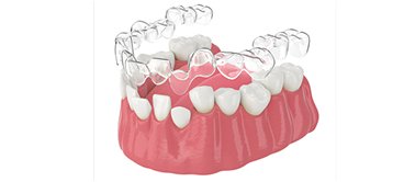 Mô hình khay niềng trong suốt trên hàm răng – giải pháp chỉnh nha thẩm mỹ tại Nha khoa Phương Thành