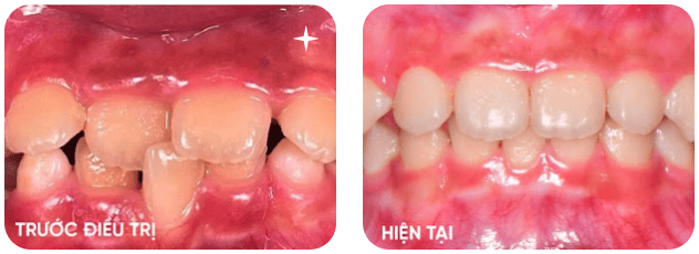 So sánh răng trước và sau điều trị – cải thiện răng lệch lạc và thẩm mỹ tại Nha Khoa Phương Thành