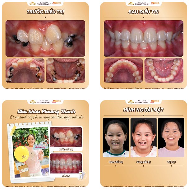Hành trình điều trị nha khoa cho trẻ – cải thiện răng lệch lạc và khuôn mặt tại Nha Khoa Phương Thành