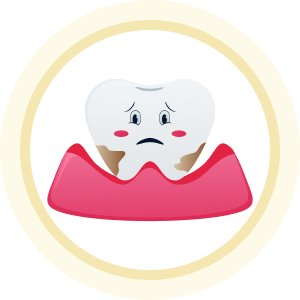 Hình minh họa răng bị mảng bám, vôi răng và nướu bị kích ứng, cần sử dụng dịch vụ cạo vôi răng và vệ sinh nha chu