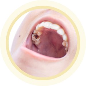 Hình ảnh răng bị sâu cần điều trị, minh họa cho dịch vụ trám răng hoặc chữa tủy tại Nha khoa Phương Thành