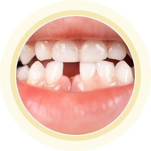 Trẻ em mất răng cửa sữa – dịch vụ nha khoa trẻ em tại Nha khoa Phương Thành