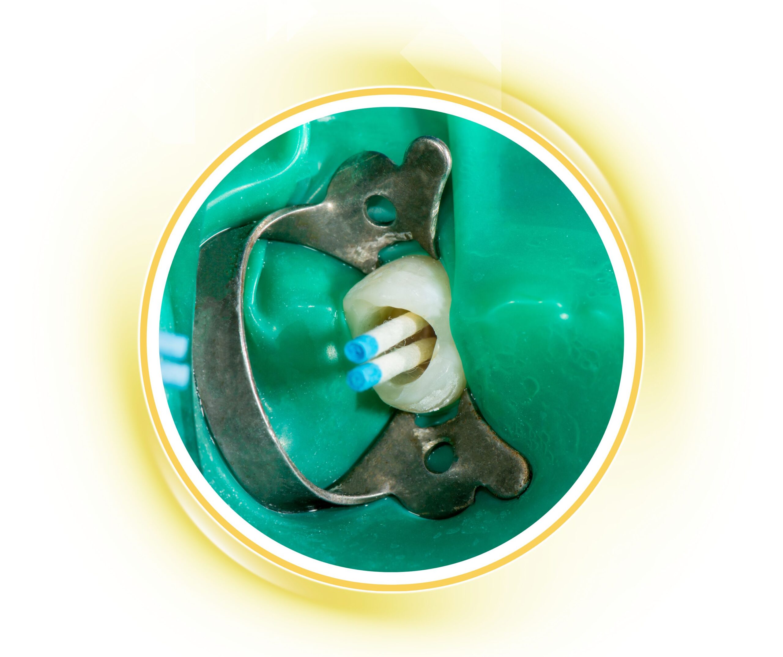 Quy trình điều trị nội nha, trám bít ống tủy bằng Gutta-Percha và cô lập bằng đê cao su tại Nha khoa Phương Thành