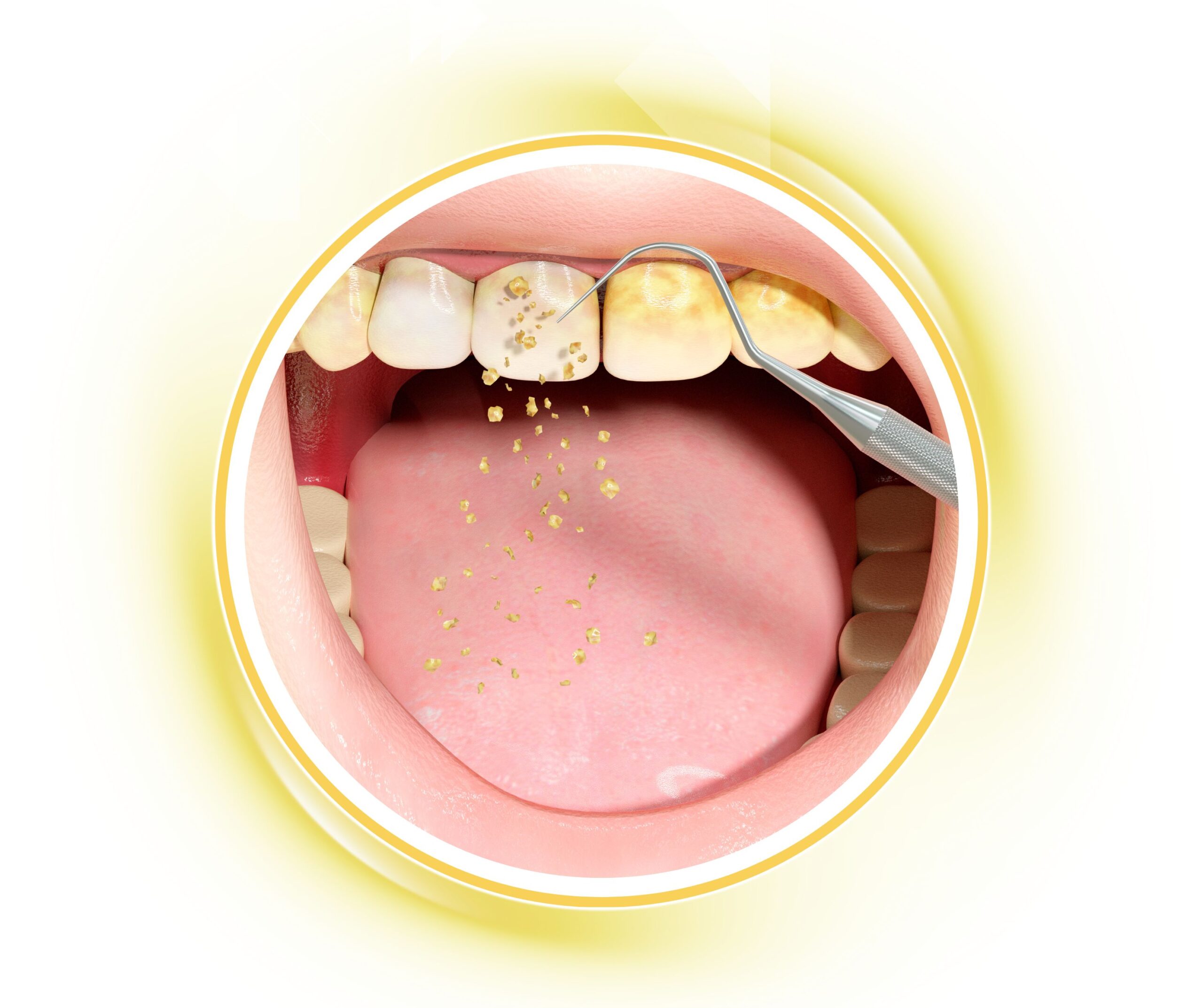 Quy trình cạo vôi răng giúp loại bỏ mảng bám và bảo vệ sức khỏe răng miệng tại Nha khoa Phương Thành
