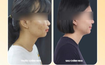 Giảm nhô, cải thiện khớp cắn nhờ chỉnh nha